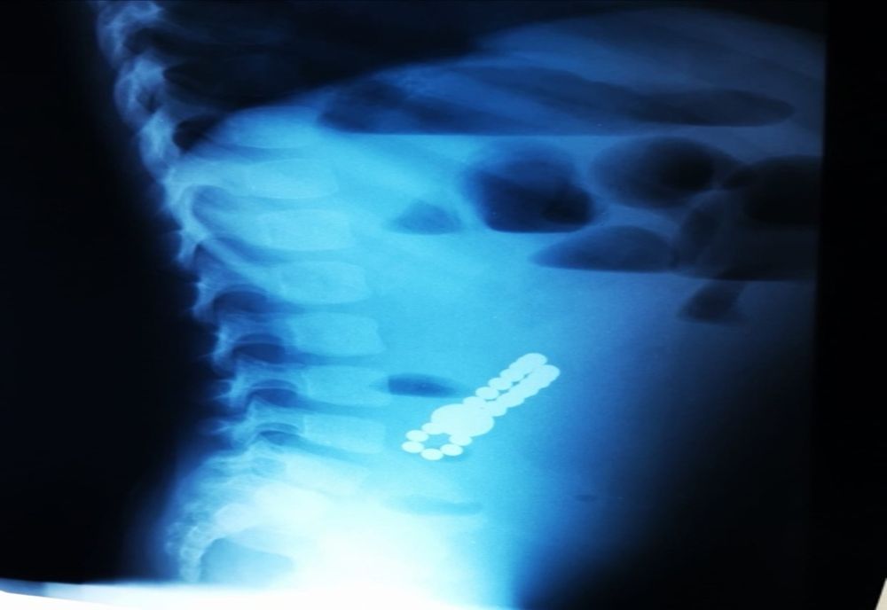 251 copii din județul Botoșani care s-au jucat cu  obiecte mici au ajuns la spital după ce le-au înghițit sau băgat în nas